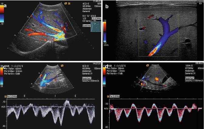 abdomen doppler