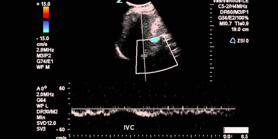 renal doppler