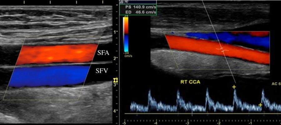 alt ekstremite arter doppler