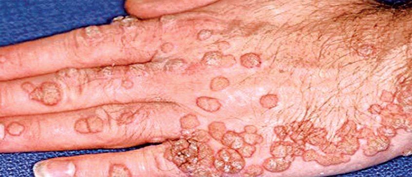 Hpv nedir nasil bulasir. Papilloma lezyon nedir