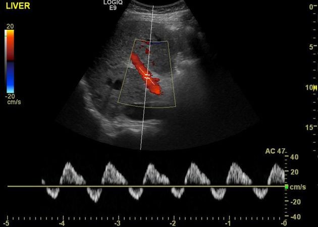 portal doppler