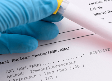 anti histon antikor testi nedir